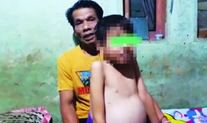 Bocah Asal Mande Cianjur Alami Pembengkakan Perut