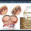 Diffuse Axonal Injury