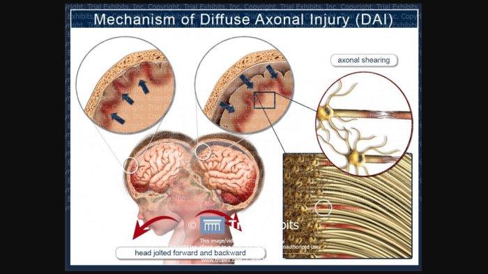 Diffuse Axonal Injury