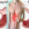 Penyakit Asam Lambung Menyebabkan Kematian