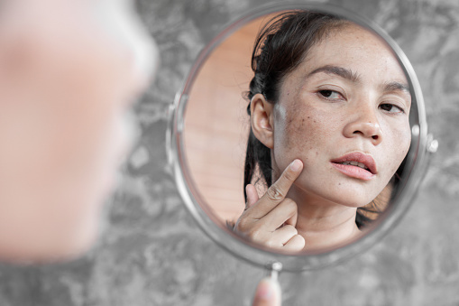 Cara Menghilangkan Flek Hitam Seperti Kumis, Yuk Coba!