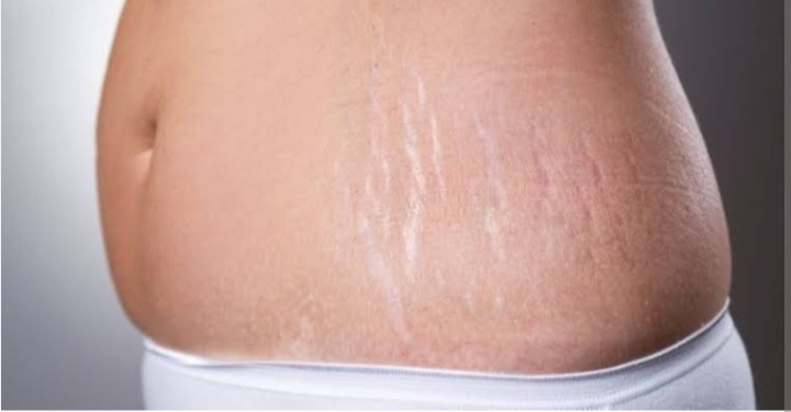 Inilah Penyebab Munculnya Stretch Mark