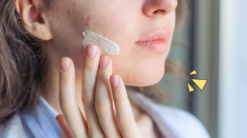 Skincare murah pengilang bekas jerawat