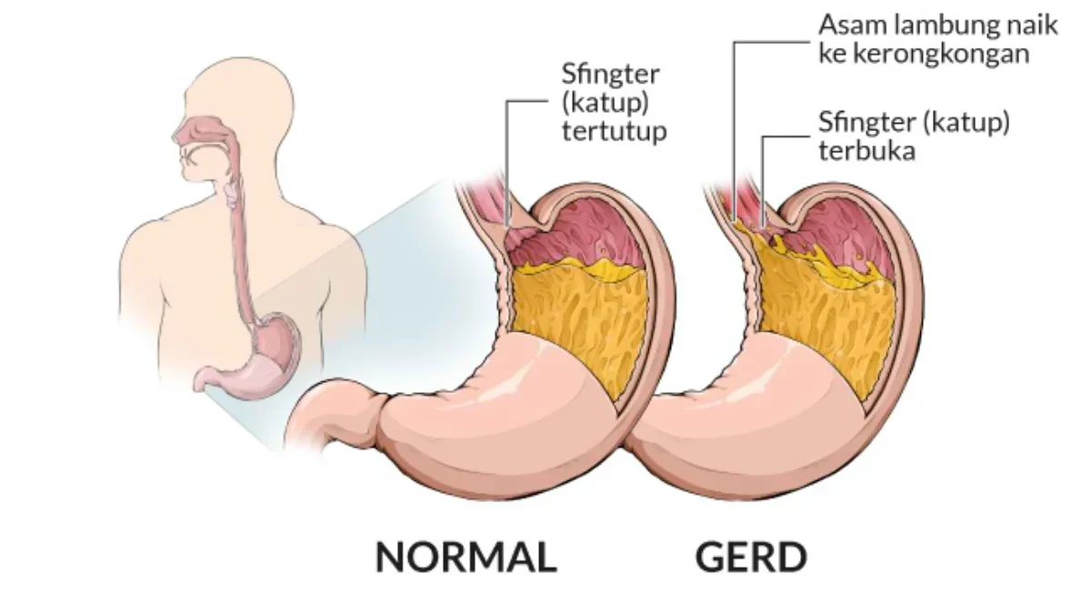 Gejala dan Faktor Penyebab Asam Lambung Naik