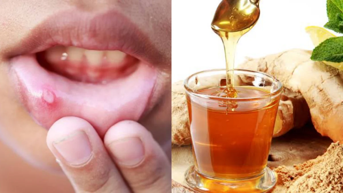 Ini Minuman Herbal yang Bisa Meredakan Sariawan! No 4 Paling Manjur