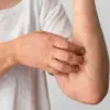 Penyebab Badan Gatal-Gatal