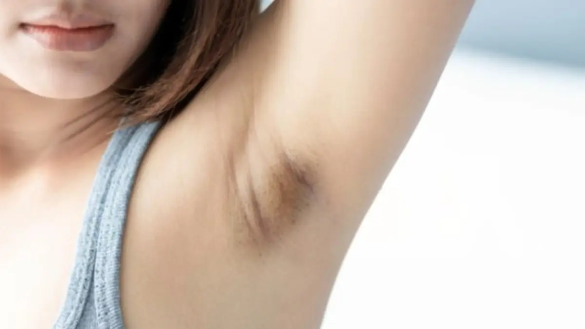 Ilustrasi ketiak gelap