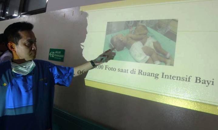 prescon-bayi-kembar-siam