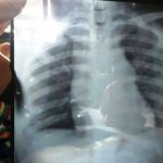 Irma Sopiani Mulai Ditangani RSHS