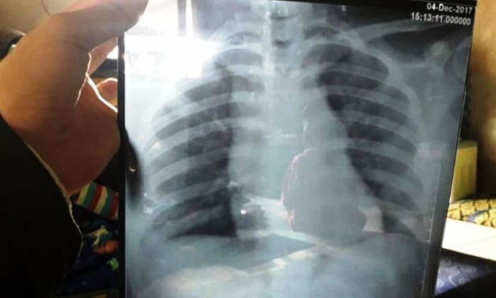 Irma Sopiani Mulai Ditangani RSHS