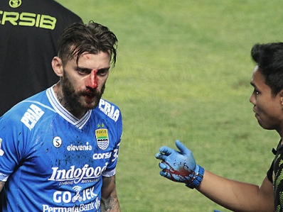 Bojan Malisic Cedera Patah Tulang Hidung