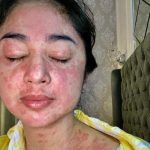 Sekujur Tubuh Dipenuhi Bintik Merah usai Sembuh dari Covid-19, Dewi Perssik Didoakan Banyak Artis