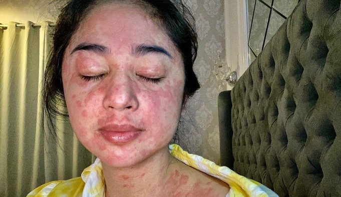 Sekujur Tubuh Dipenuhi Bintik Merah usai Sembuh dari Covid-19, Dewi Perssik Didoakan Banyak Artis