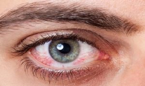 Tips Atasi Mata Kering Akibat Memakai Masker Tips Atasi Mata Kering Akibat Memakai Masker