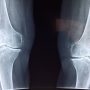 Dokter Reumatologi: Wanita Lebih Berisiko Terkena Osteoporosis