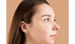 kulit kemerahan skincare