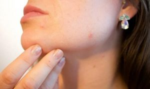 ilustrasi mengatasi jerawat dengan minuman berkhasiat