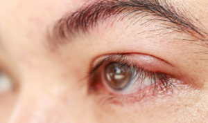 Ilustrasi mata bintitan