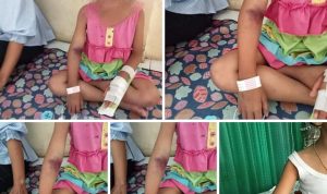 Tangan seorang bocah mengalami lebam seusai di rawat di RS. (tangkapan layar facebook)