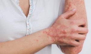 virus cacar monyet