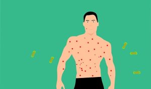 Sepekan, Cacar Monyet di Belanda Meningkat Dua Kali Lipat, Seluruh Pasiennya Kaum Penyuka Sesama Jenis Ilustrasi Cacar Monyet yang menjangkiti kaum sesama jenis di BAlanda. (pixabay)