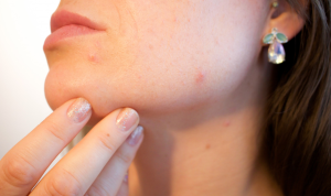 Empat Suplemen Penghilang Jerawat, Dijamin Ampuh!