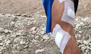 Kondisi kaki korban yang mengalami luka-luka. Kini terungkap motif istri yang nyaris potong burung di bekasi tersebut. Foto: Instagram.com/polsek_cikarangutara