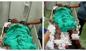 Korban ledakan di asrama Polisi yang mengalami luka bakar hingga 70 persen.