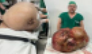 Viral, Tumor Sebesar Bayi Kudanil Berhasil Diangkat dari Perut Seorang Wanita, Dokter Sebut Beratnya Mencapai 100 Pon foto tumor besar yang berhasil diangkat oleh tim dokter kini viral di media sosial. (Dr. Glaucio Boechat-Facebook)