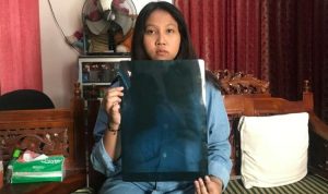 Paru-paru Korban Kanjuruhan Ini Penuh Flek Putih Bekas Gas Air Mata, Dada Sesak hingga Tak Bisa Sekolah
