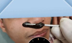 Seekor Lintah Bersarang di Dalam Hidung Jamal, Kok Bisa? Seerkor lintah sebesar ibu jari orang dewasa ditemukan di dalam hidung seorang warga Desa Cibadak, Kecamatan Sukamakmur, Kabupaten Bogor.