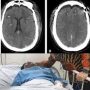 Dampak Kekerasan Fisik atas penganiayaan mario dandy Hingga Diffuse Axonal Injury