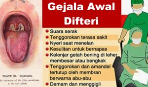 Dinkes Jabar Temukan 11 Kasus Difteri di Luar Garut Cimahi Waspadai Suspek Difteri, Dikes Anjurkan Warga Segera Periksa Jika Rasakan Gejal