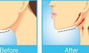 tips menghilangkan Lemak di Dagu