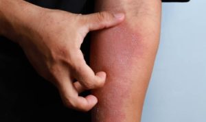 Rekomendasi obat gatal alami yang paling ampuh. (pixabay)