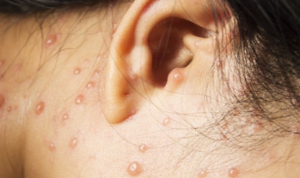 Obat Tradisional Cacar Air Agar Cepat Kering