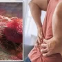 8 Obat Prostat Alami Tanpa Operasi yang Paling Ampuh