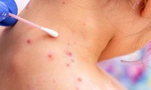 Gejala dan cara mencegah pelaran cacar air