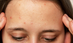 Cara Menghilangkan Bruntusan di Jidat