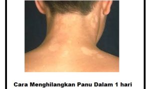 Panu Kulit?? Tips Cara Menghilangkan panu dalam waktu 1 hari!!! Cara Menghilangkan panu dalam 1 hari