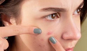 Hindari! Kandungan Skincare yang Tidak Cocok untuk Kulit Berjerawat Hindari! Kandungan Skincare yang Tidak Cocok untuk Kulit Berjerawat