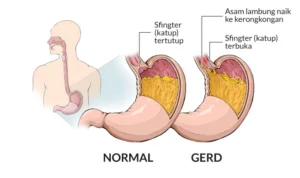 Mengenal Lebih Dekat Penyakit GERD dan Cara Mengatasinya