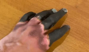 Frostbite (Radang Dingin) Adalah - Penyebab dan Cara Mengobati