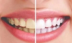 Senyum Percaya Diri! Ini Dia 6 Tips Cara Agar Gigi Tidak Kuning