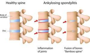 Kenali Ankylosing Spondylitis Penyakit "Manusia Kayu" Kenali Ankylosing Spondylitis Penyakit "Manusia Kayu"