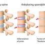 Kenali Ankylosing Spondylitis Penyakit "Manusia Kayu"