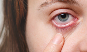 5 Cara Atasi Mata Merah, Perhatikan Ini!