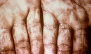 Jawa Barat Darurat Penyakit Sifilis!