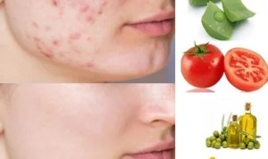 Mau Kulit Cantik Bebas Jerawat? Berikut 10 Cara Alami Menghilangkan Jerawat