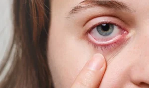 Berikut ini adalah penjelasan tentang penyebab, pengobatan dan cara mencegah mata bintitan